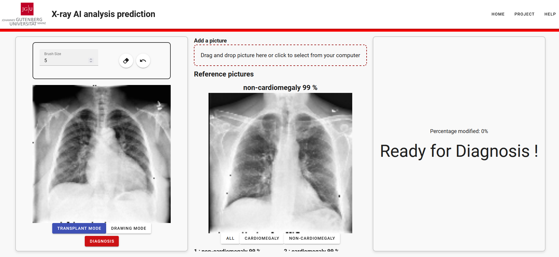 Cardiomegaly CNN